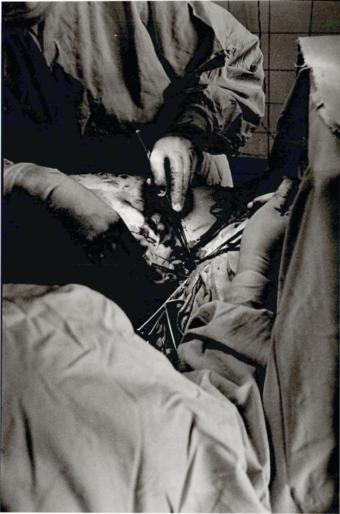 During  abdominal surgery where the patient was completely awake.
