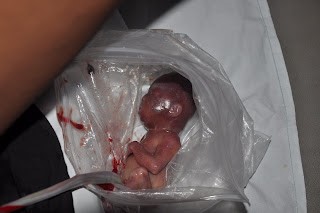 baby abortion