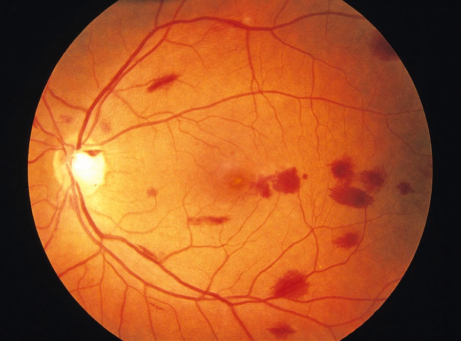 RETINAL