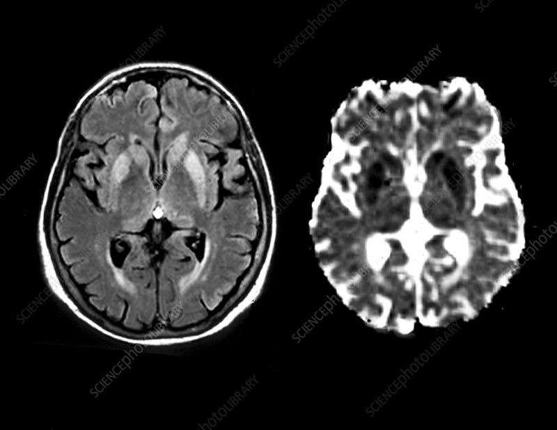 Brain in Creutzfeldt-Jakob disease, MRI - Stock Image - C023/9784 - Science  Photo Library